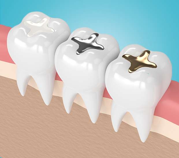 McKinney Tooth Colored Fillings