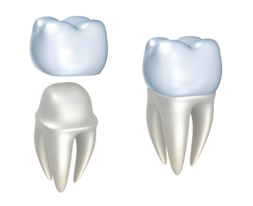 How We Use Dental Crowns In McKinney To Restore Damaged Teeth