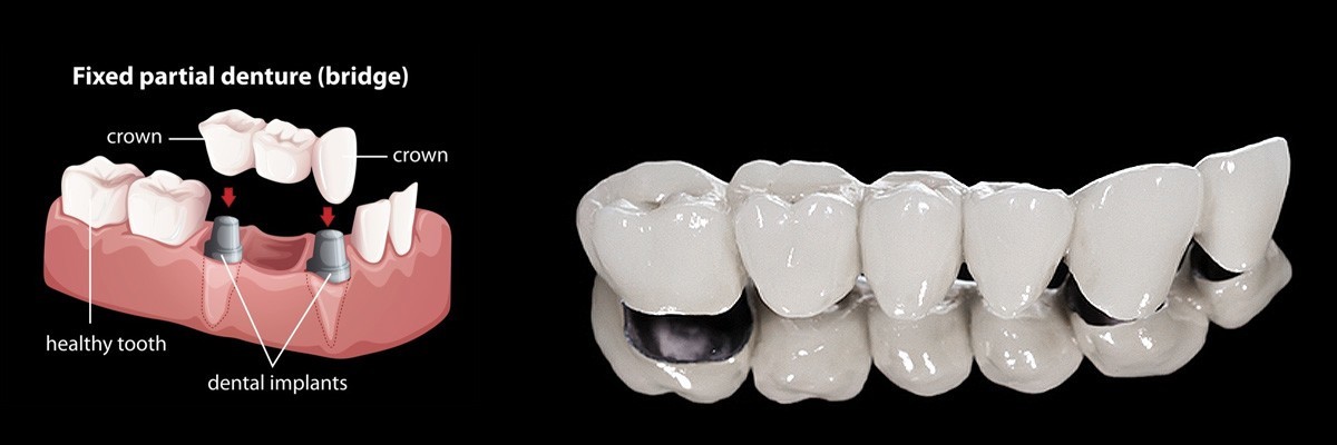 McKinney Dentures