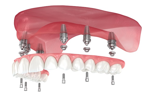 Implant Supported Dentures McKinney, TX