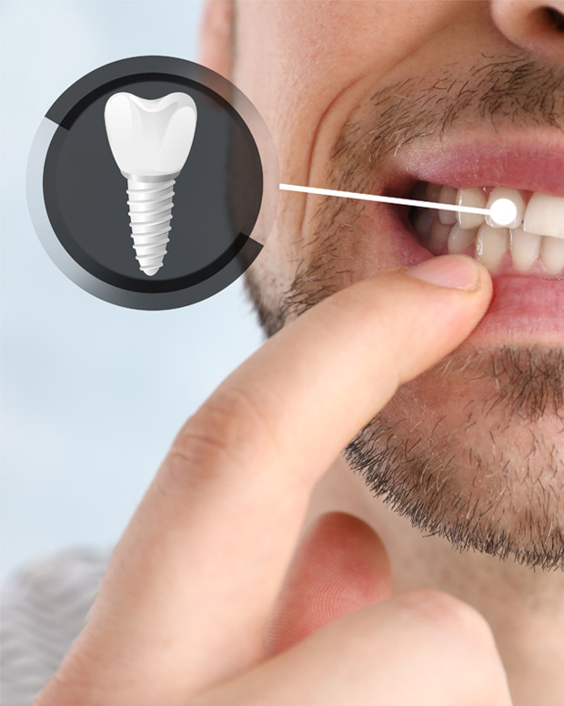 Services Dental Implants