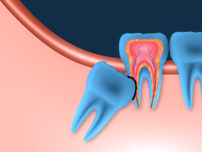 Wisdom Tooth Extractions