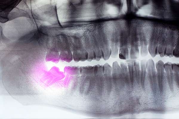 What Are Impacted Wisdom Teeth?