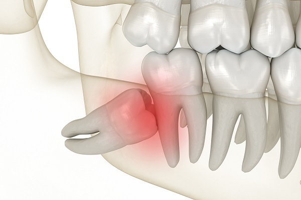 When To Consider Wisdom Tooth Removal